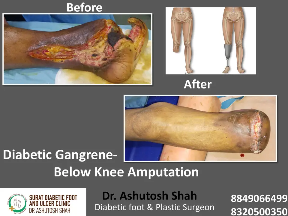 Diabetic Foot  PPT sunita.pptx-18.webp